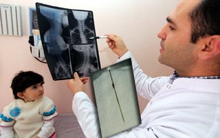 Çocuğun karnından çıkan doktoru da şaşırttı